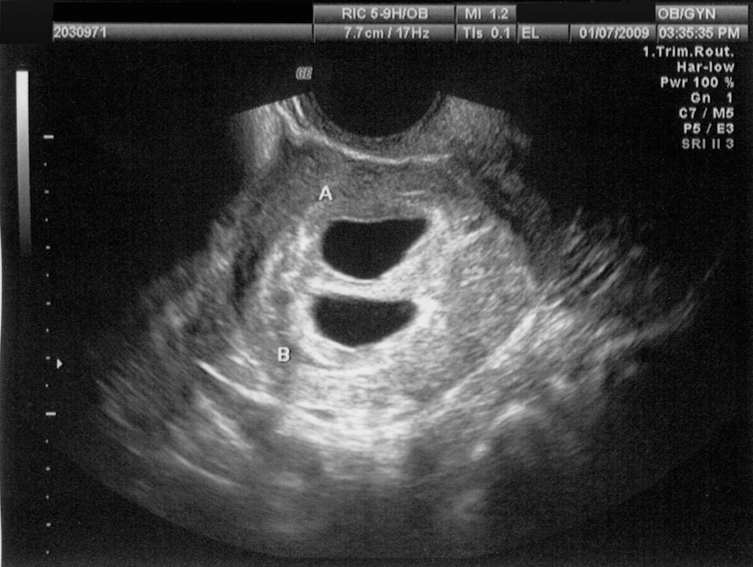 pics Early Signs Of Twin Pregnancy 6 Weeks