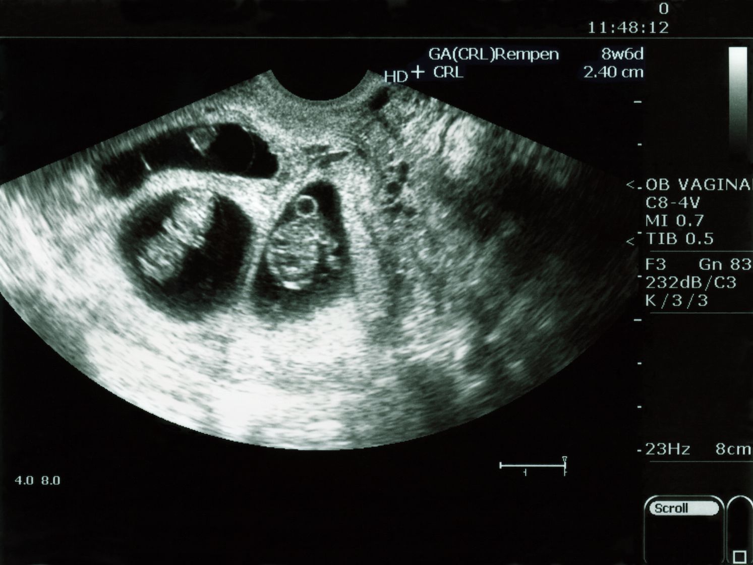 picture Early Signs Of Twin Pregnancy 6 Weeks