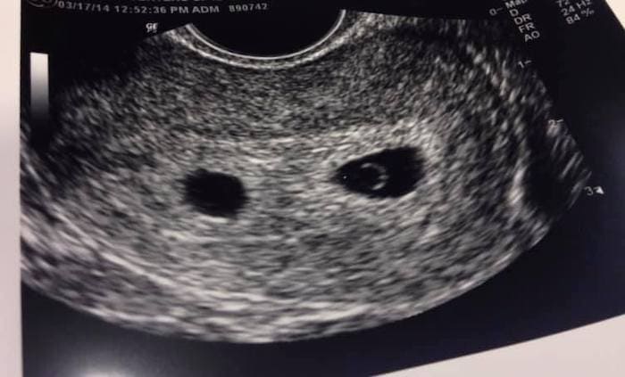 photo Early Signs Of Twin Pregnancy 6 Weeks