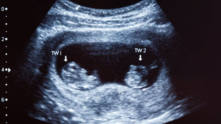 images Early Signs Of Twin Pregnancy 6 Weeks