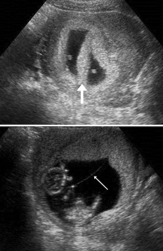 pic Early Signs Of Twin Pregnancy First 2 Weeks