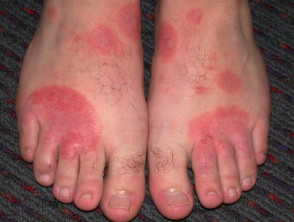 Featured image of post Flip Flop Rash&#039; Pictures